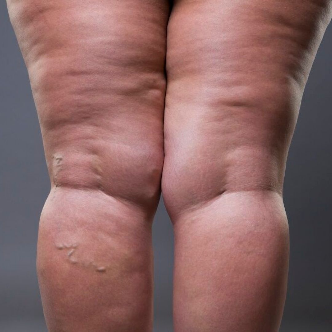 Drenagem Específica para Lipedema e Linfedema